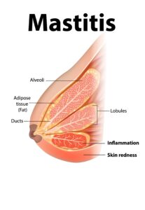 Mastitis