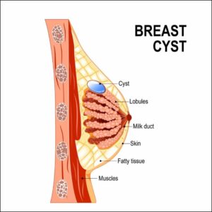 Breast Cysts